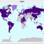 Bản đồ thế giới thể hiện tỷ lệ mắc bệnh Lupus