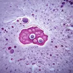 Hình ảnh polyp túi mật